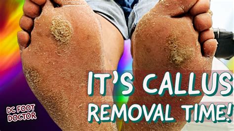 Why Mail Aid's Callus Remover is a Must-Have Beauty Essential